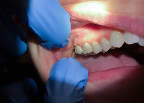 Best Broken or Chipped Tooth Repair in Blanco, TX